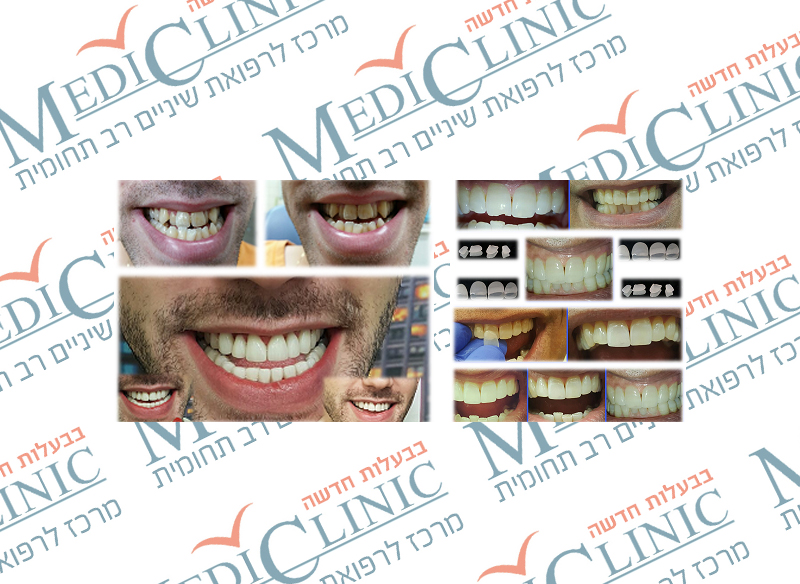 מרפאה שיניים בתל אביב  מציעה מגוון רחב של טיפולי אסתטיות באמצעות ציפויי חרסינה (למינייט).